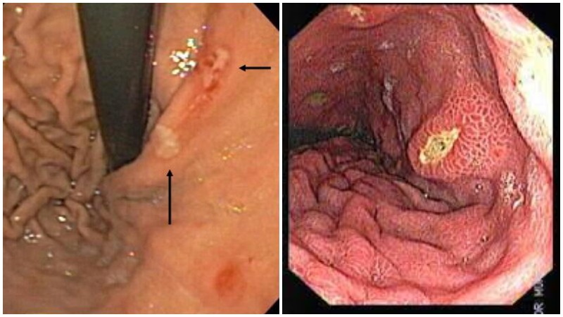 عکس آندوسکوپی از زخم معده