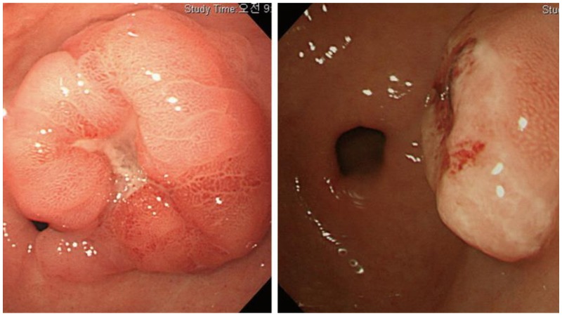 عکس آندوسکوپی از سرطان معده
