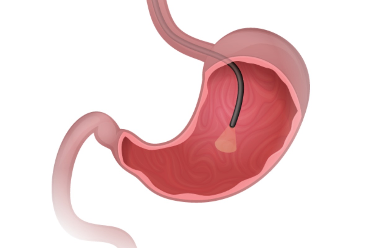 زخم معده در اندوسکوپی