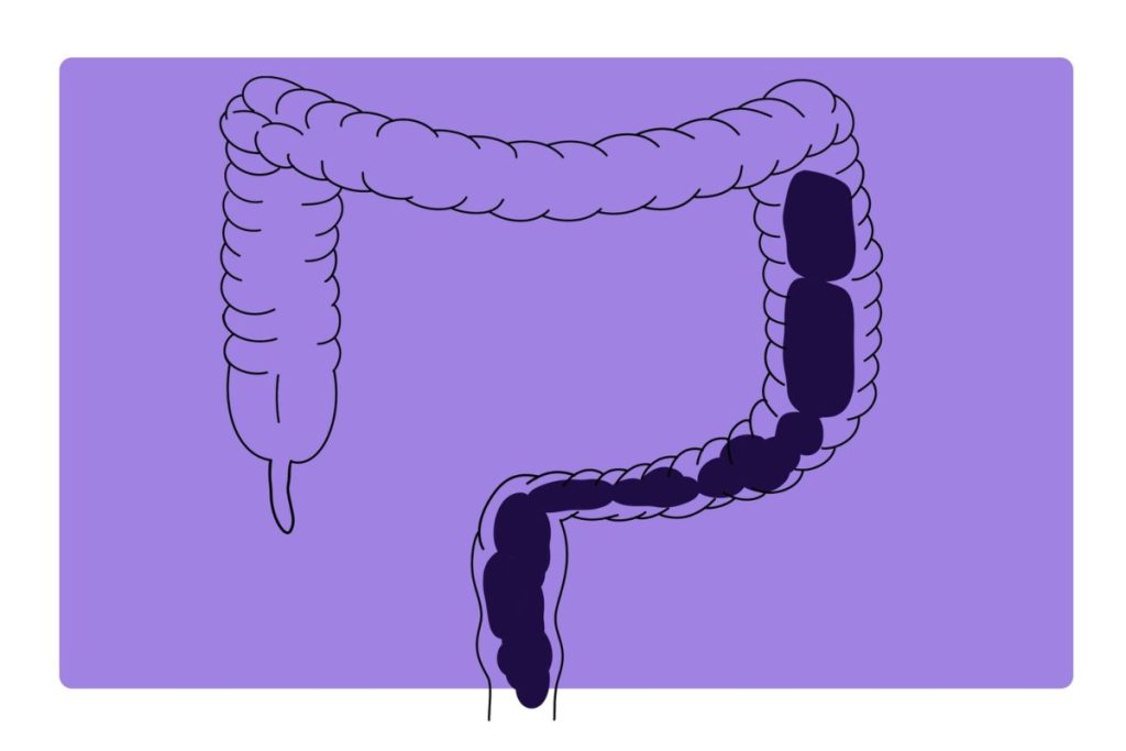 شکل مدفوع در سندروم روده تحریک پذیر