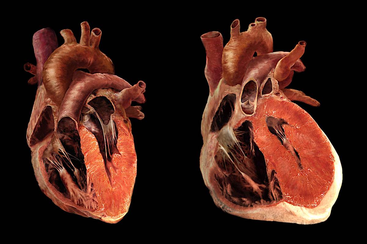 بزرگ شدن قلب