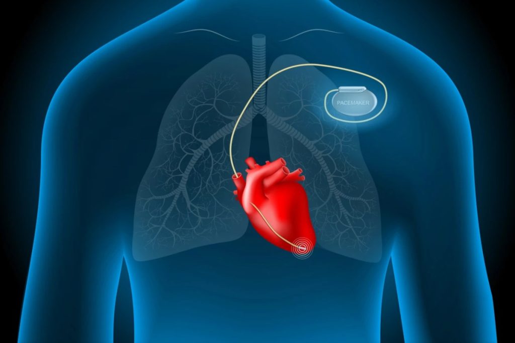 عمر کسانی که باتری قلب دارند چقدر است؟