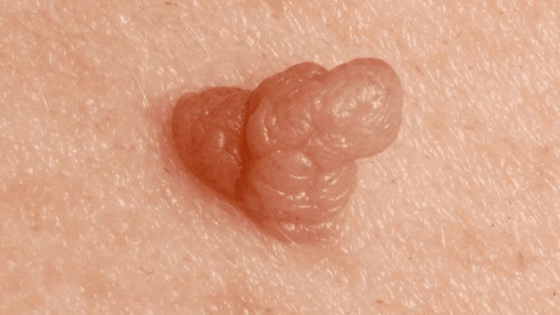 عوارض HPV برای دختران مجرد (باکره) عوارض HPV برای دختران مجرد (باکره)