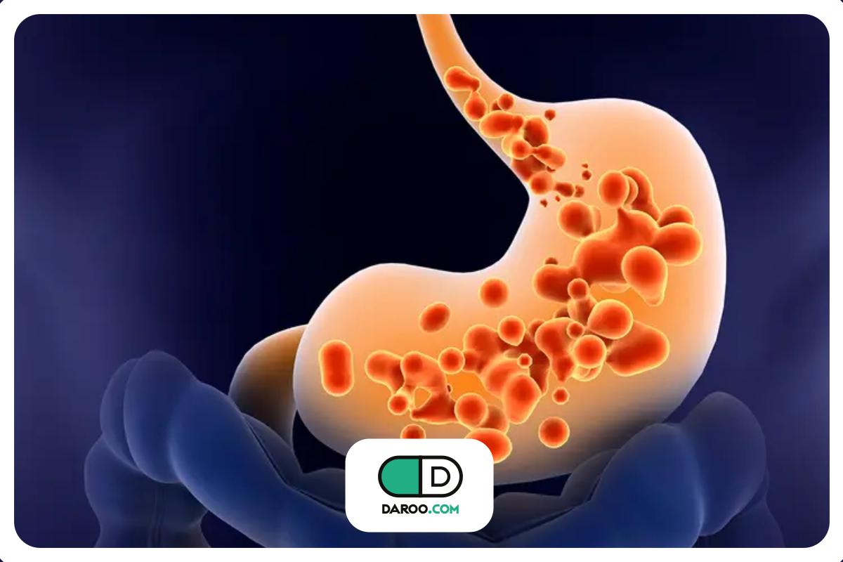 علل رفلاکس معده