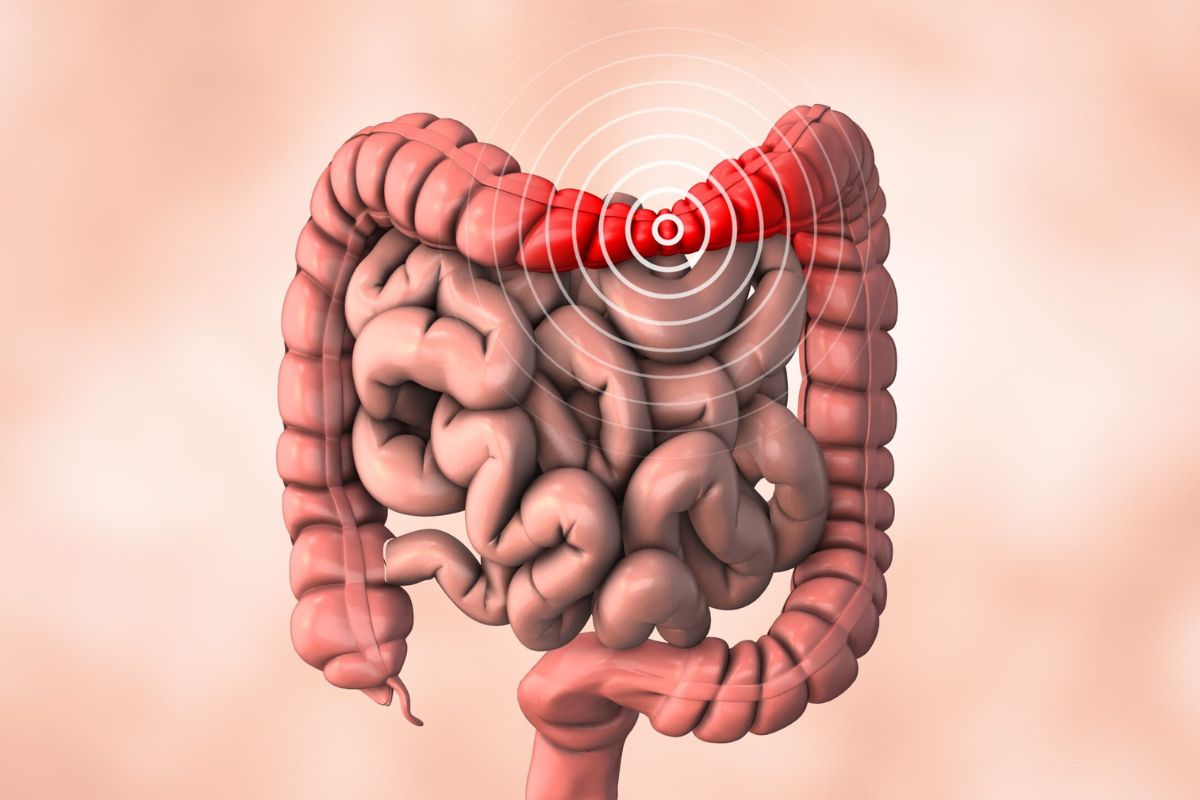 سندرم روده تحریک پذیر