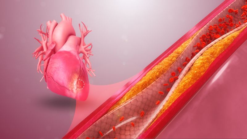 مراحل گرفتگی رگ قلب و علائم هر مرحله