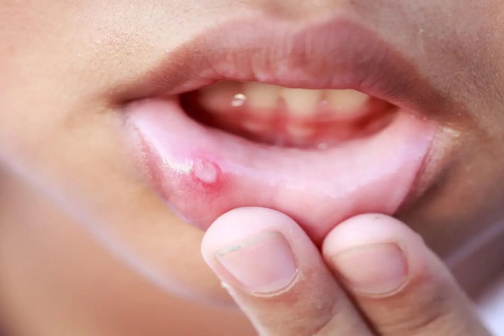 علائم زگیل دهانی در مردان و زنان؛ بررسی دلایل، پیشگیری و درمان