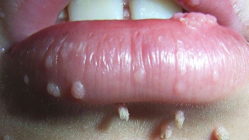 علائم زگیل دهانی در مردان و زنان