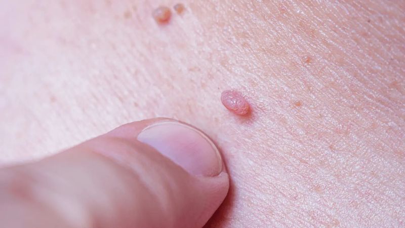 مزایای لیزر زگیل تناسلی