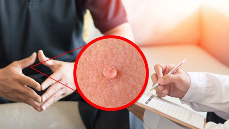 درمان دارویی زگیل تناسلی در مردان