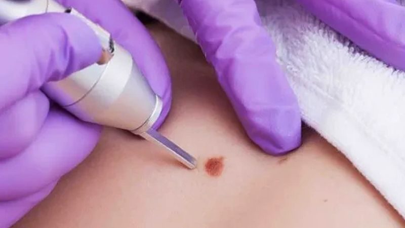 عوارض لیزر زگیل تناسلی