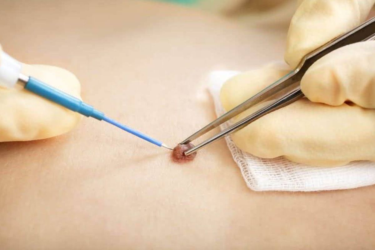 لیزر زگیل تناسلی