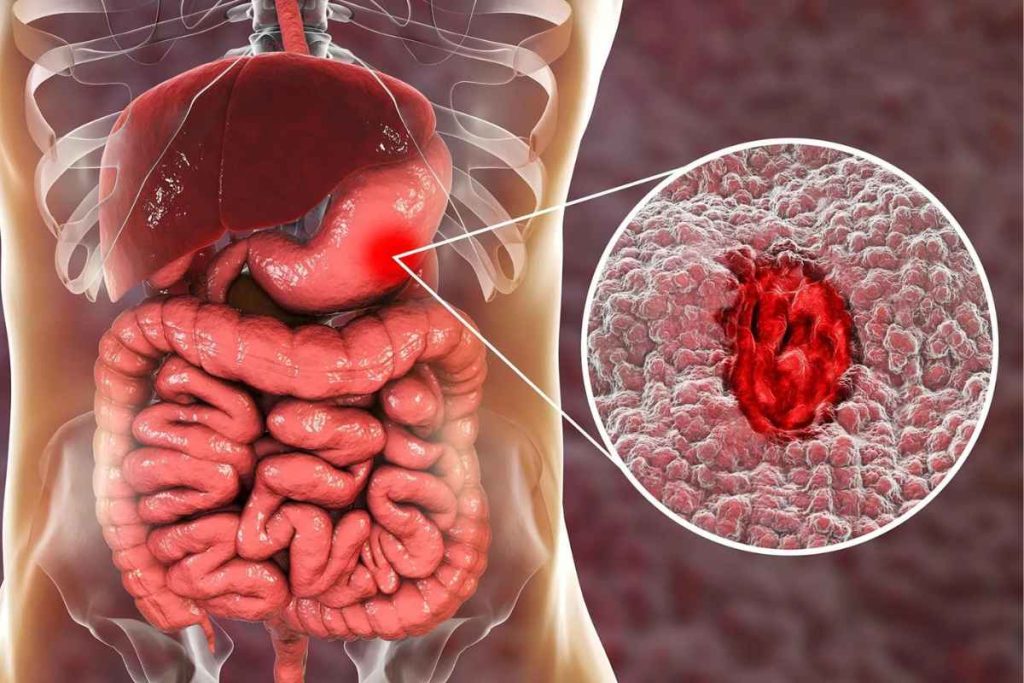 انواع زخم معده