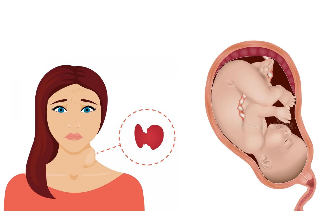 پرکاری تیروئید و بارداری