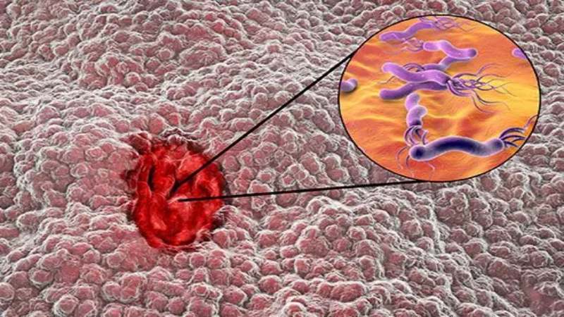 زخم معده در اثر عفونت باکتریایی