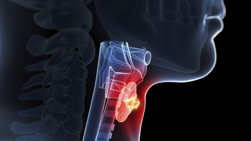 علائم و نشانه‌های طوفان تیروئید