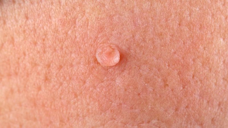 عوارض زگیل تناسلی