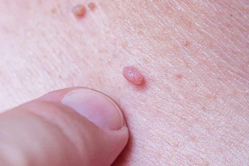 علائم، علت و راه‌های پیشگیری زگیل تناسلی