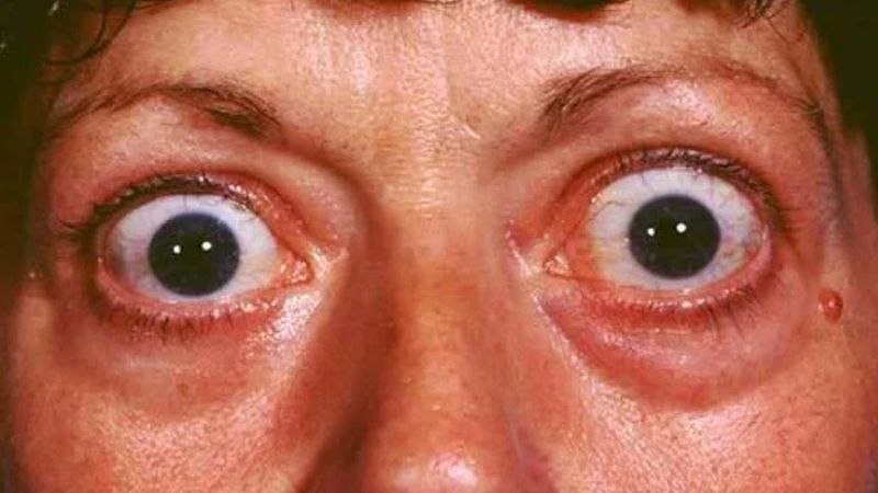 علائم و نشانه‌های بیماری گریوز