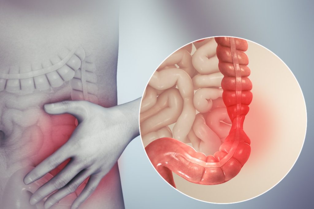 خطرات سندروم روده تحریک پذیر