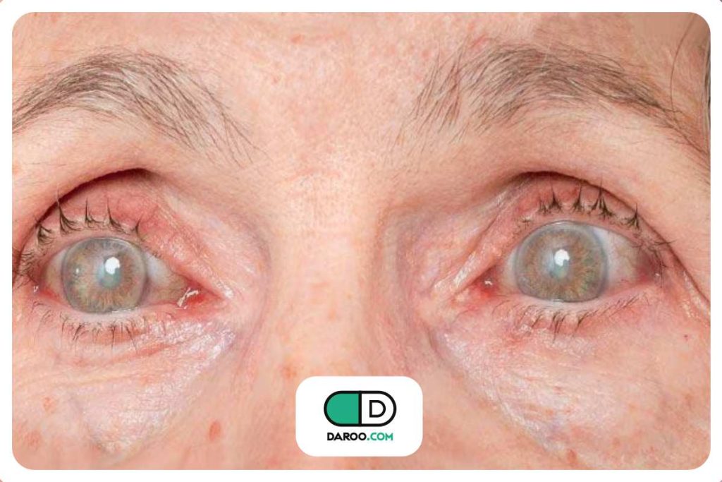 نابینایی ناشی از دیابت