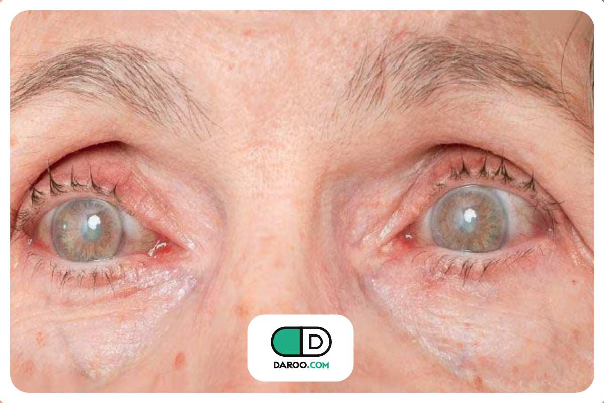 نابینایی ناشی از دیابت