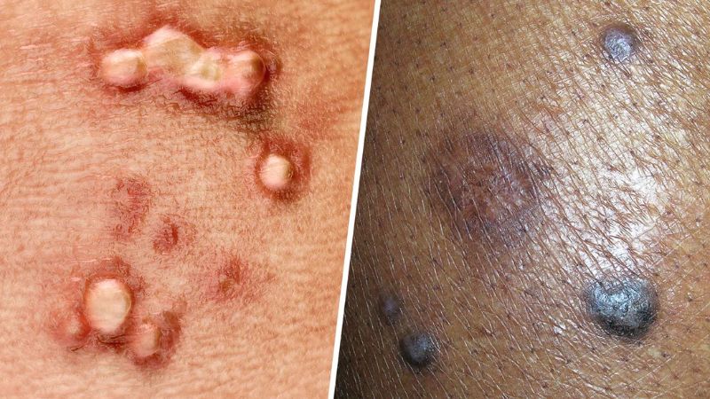 عوارض زگیل تناسلی (HPV) برای دختران مجرد (باکره) عوارض زگیل تناسلی (HPV) برای دختران مجرد (باکره)