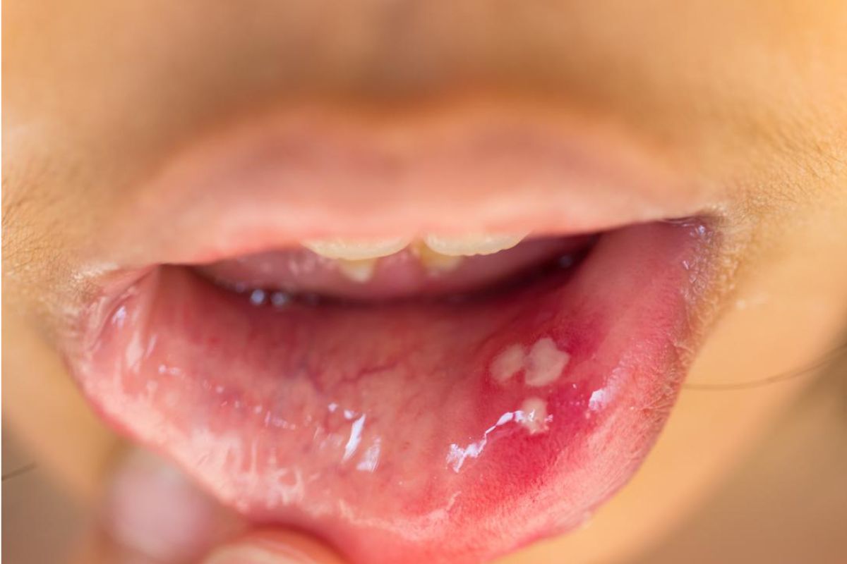 امکان انتقال ویروس HPV از طریق بزاق دهان و بوسیدن