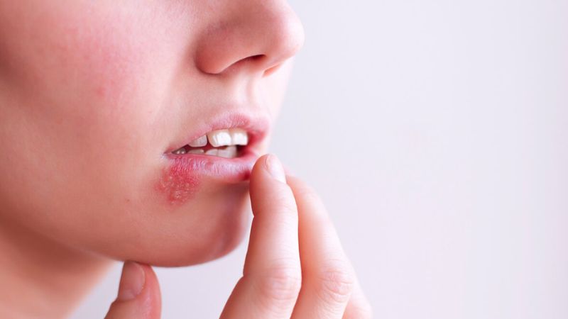 خطر ابتلا به HPV دهانی یا زگیل دهانی خطر ابتلا به HPV دهانی یا زگیل دهانی