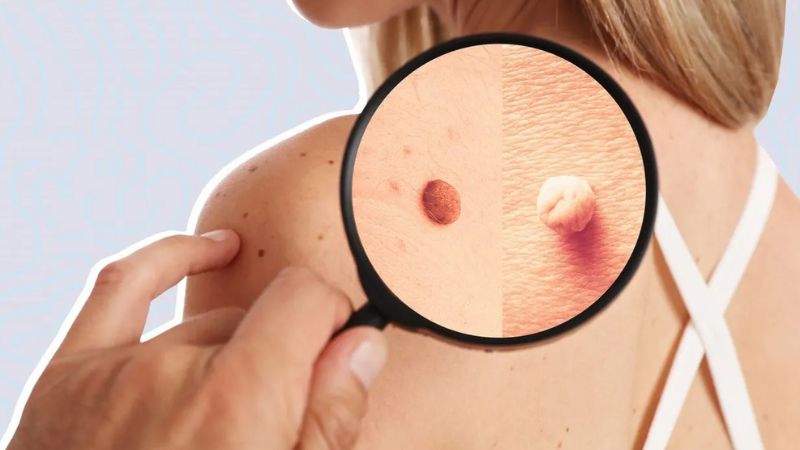 دلایل گوشت اضافه (منگوله پوستی) در مقابل زگیل دلایل گوشت اضافه (منگوله پوستی) در مقابل زگیل