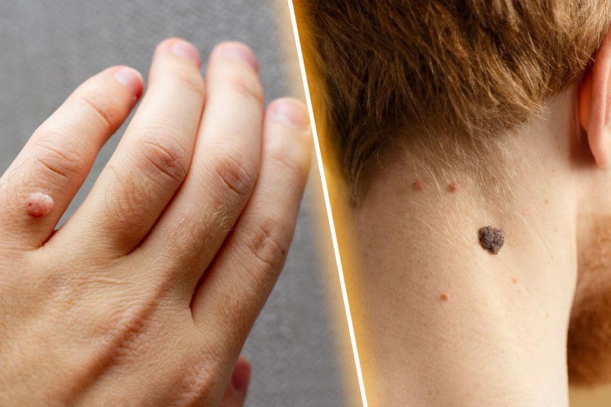 فرق گوشت اضافه (اسکین تگ) و زگیل تناسلی