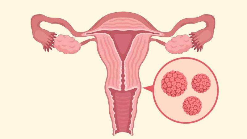 چشم‌انداز زنان باردار مبتلا به زگیل تناسلی و HPV