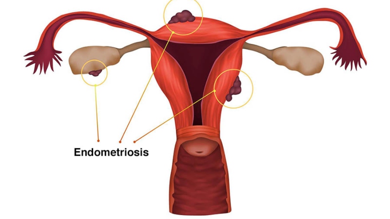 آندومتریوز