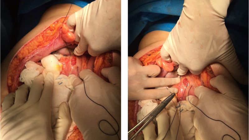 انواع روشهای جراحی زخم معده انواع روشهای جراحی زخم معده