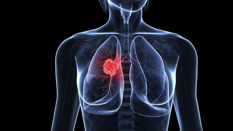 تأیید داروی جدید برای سرطان ریه غیرسلولی