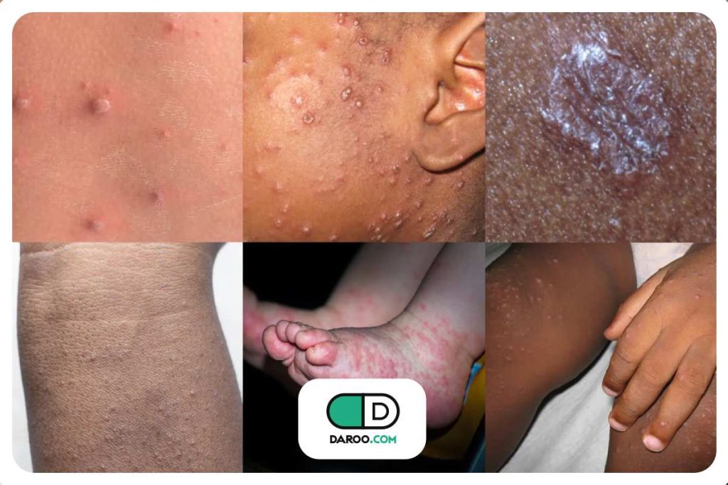 علائم پوستی دیابت کودکان