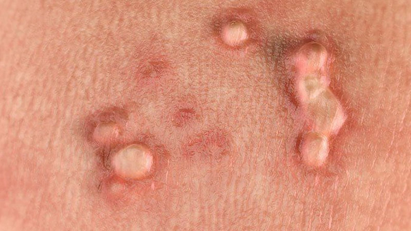 بهترین داروها برای از بین بردن زگیل تناسلی