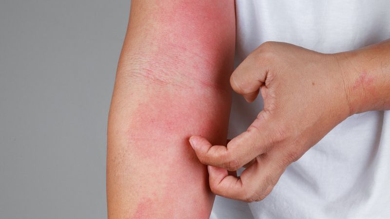 ‏لیست بهترین دارو برای خارش بدن