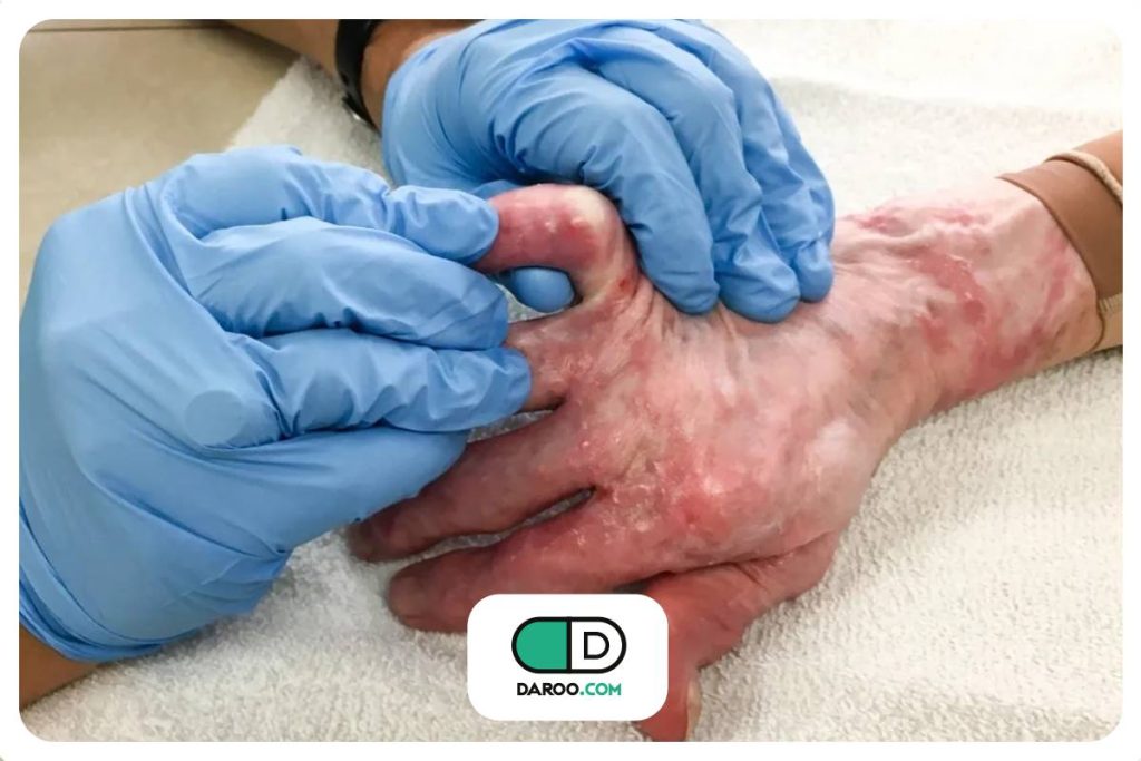 آیا فیزیوتراپی می‌تواند روند درمان سوختگی را بهبود دهد؟