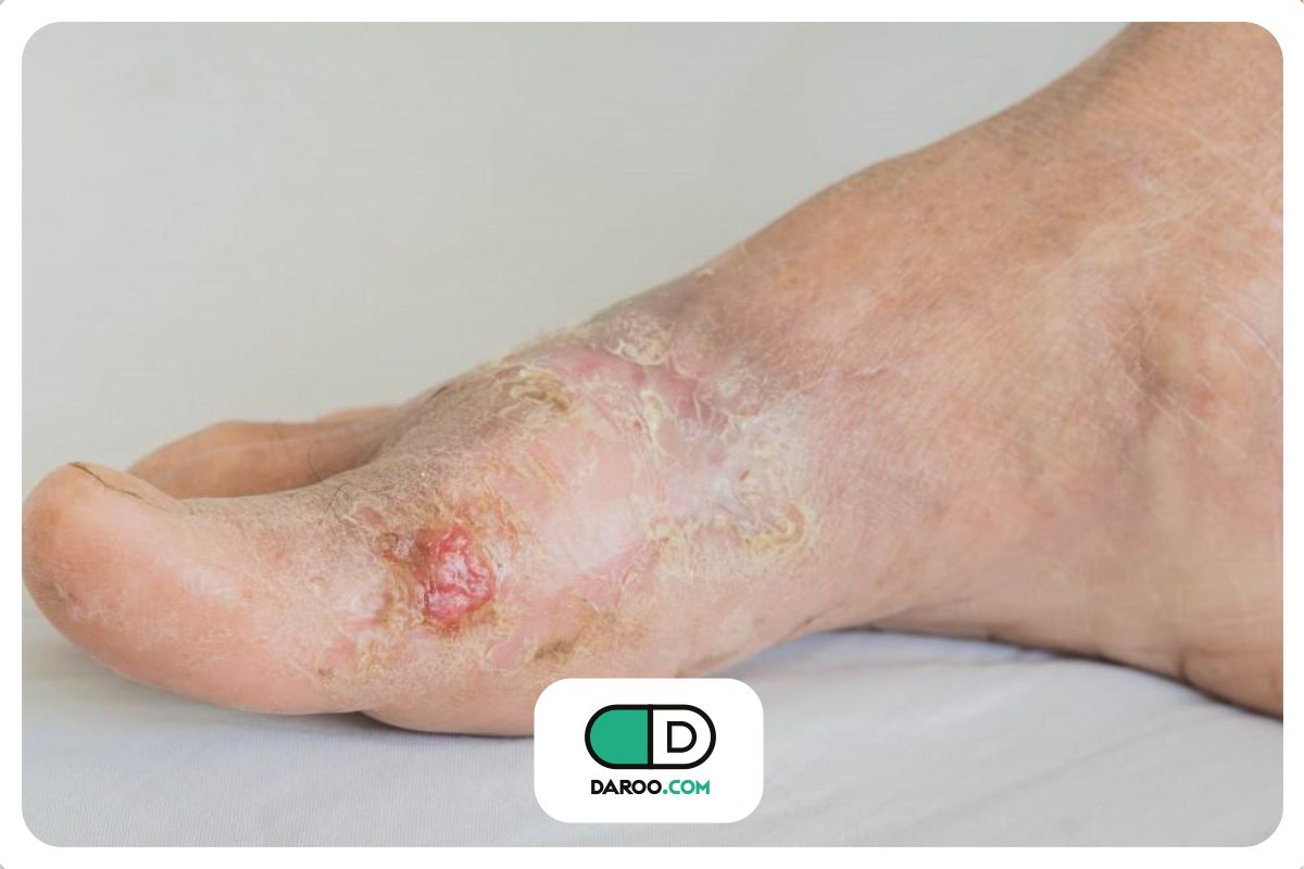 قطع عضو در اثر دیابت