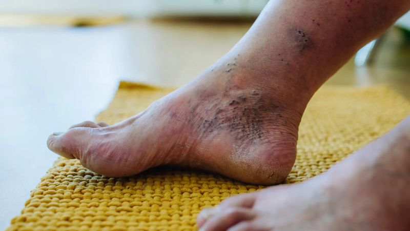 انواع زخمهای پای دیابتی انواع زخمهای پای دیابتی