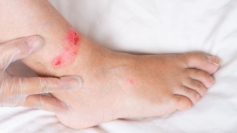 نکاتی در پیشگیری از زخم پای دیابتی