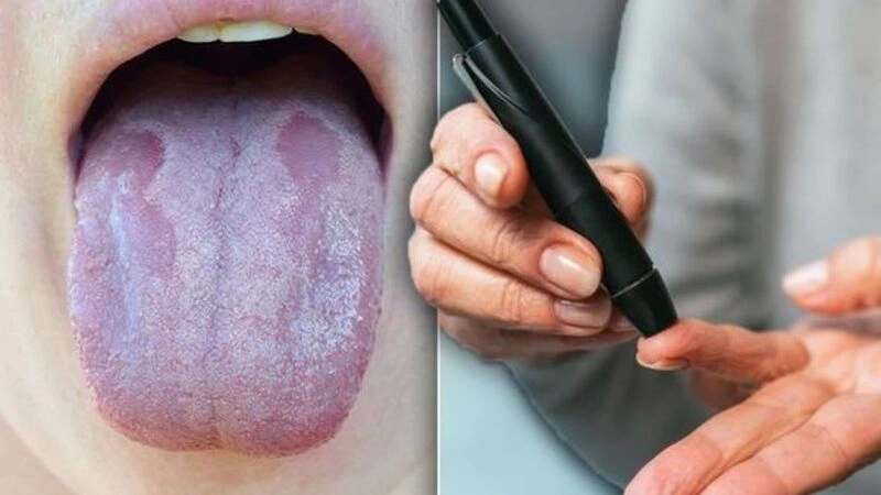 چگونه با مشاهده زبان، احتمال دیابت را بررسی کنیم؟