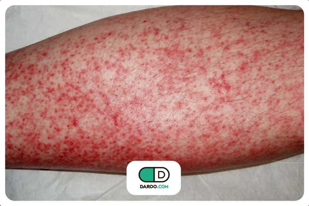 علائم و علت بیماری dress یا سندرم دِرِس