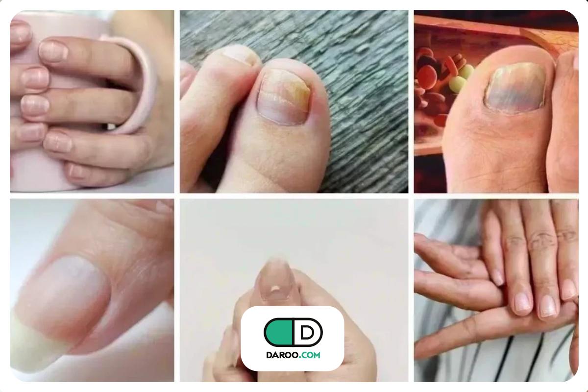 علائم هشداردهنده کلسترول بالا که در ناخن‌ها دیده می‌شوند
