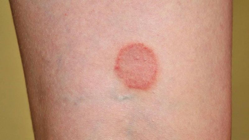 عفونت قارچی