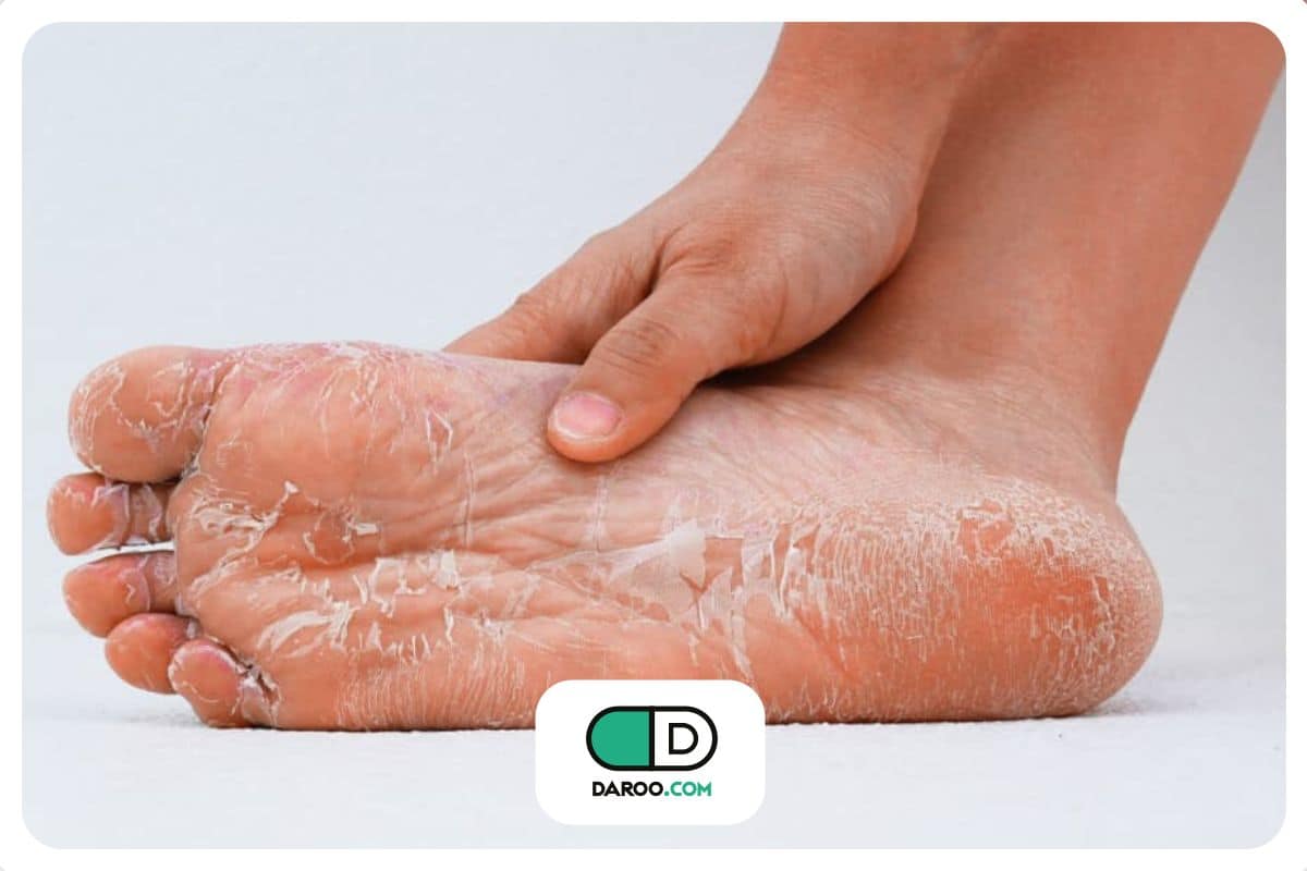 علائم پوستی دیابت در کودکان