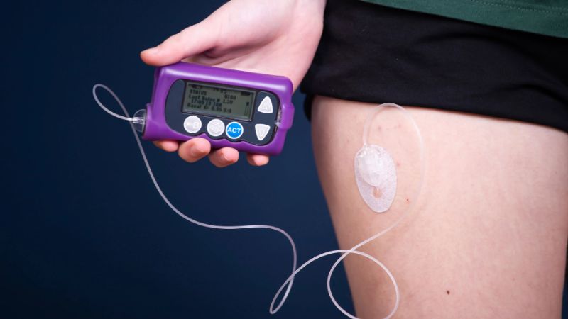 انواع پمپ‌ انسولین