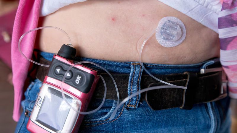 معایب پمپ‌ انسولین