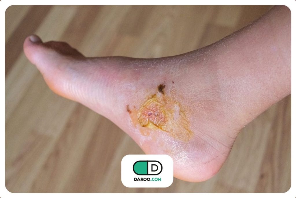 علائم و نشانه‌های اولیه زخم پای دیابتی